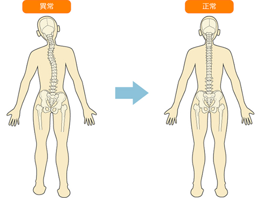 背骨や骨盤の異常と正常の図